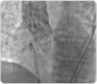 Trans Catheter Aortic Valve Implantation (TAVI)