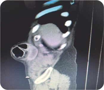 Traumatic Abdominal Hernia - Laparoscopic Reduction and Repair by IPOM-Plus