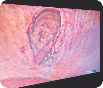 Traumatic Abdominal Hernia - Laparoscopic Reduction and Repair by IPOM-Plus