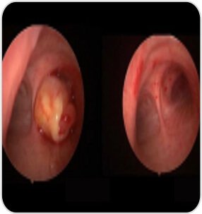 Tumor Removal by Bronchoscopy Case-1d