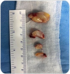 Tumor Removal by Bronchoscopy Case-1e