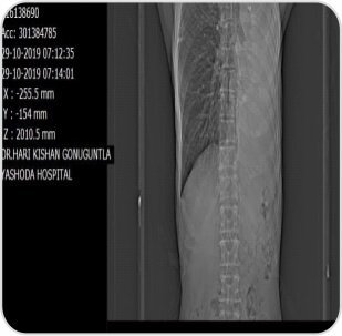 Tumor Removal by Bronchoscopy Case-2c