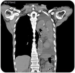 Tumor Removal by Bronchoscopy Case-2d