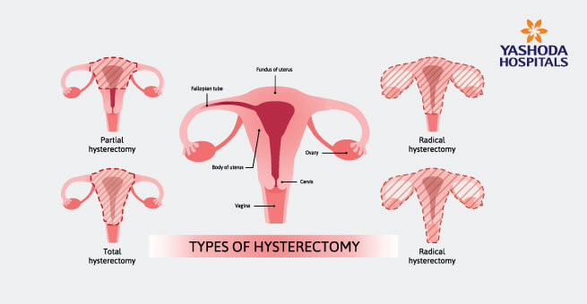 Types of hysterectomy