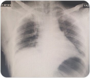 Video-Assisted Thoracoscopic Surgery of Solitary Fibrous Pleural TumorDr. BalasubramoniumMS (General Surgery), MCh(CVTS) Dr. Siva Prasad GoudMBBS, DNB (CVTS)Robotic & Minimally Invasive Thoracic Surgeon,Yashoda Hospitals, SecunderabadBACKGROUNDDIAGNOSIS & TREATMENTA 51 years old male patient came with a history of dyspnoea on exertion and purulent cough since 6 months. Pleural fluid aspiration was performed -6 times over 2 months. (1 - 1.5 litres of hemorrhagic pleural fluid was aspirated)Routine Investigations – WNLPFT:FVC – 1.26  FEV1 – 1.1  FEV1/FVC – 87.1ECHO – normal LV function , No RWMA  Pre procedure chest radiographs showingmassive right pleural effusionCT scan showing solitary fibrous right pleural tumor CTscanshowedtwolargeheterogenouslyenhancing pleural based soft tissue density lesions with neovascularity in right hemithorax measuring 14.3x13.4x11.5cm and  7.9x7.5x6.1cm.Surgery - Pleural aspiration was done and 2 litres of fluid was drained. Patient developed hemodynamic instability and was resuscitated in OT. Right posterolateral thoracotomy was performed and the tumor was removed under VATS.Post op chest X rayRight pleural tumorVideo-Assisted Thoracoscopic Surgery Uniportal Bullectomy