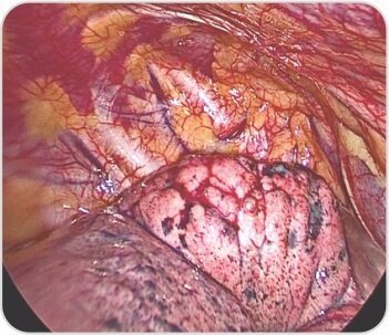 Video-Assisted Thoracoscopic Surgery of Solitary Fibrous Pleural TumorDr. BalasubramoniumMS (General Surgery), MCh(CVTS) Dr. Siva Prasad GoudMBBS, DNB (CVTS)Robotic & Minimally Invasive Thoracic Surgeon,Yashoda Hospitals, SecunderabadBACKGROUNDDIAGNOSIS & TREATMENTA 51 years old male patient came with a history of dyspnoea on exertion and purulent cough since 6 months. Pleural fluid aspiration was performed -6 times over 2 months. (1 - 1.5 litres of hemorrhagic pleural fluid was aspirated)Routine Investigations – WNLPFT:FVC – 1.26  FEV1 – 1.1  FEV1/FVC – 87.1ECHO – normal LV function , No RWMA  Pre procedure chest radiographs showingmassive right pleural effusionCT scan showing solitary fibrous right pleural tumor CTscanshowedtwolargeheterogenouslyenhancing pleural based soft tissue density lesions with neovascularity in right hemithorax measuring 14.3x13.4x11.5cm and  7.9x7.5x6.1cm.Surgery - Pleural aspiration was done and 2 litres of fluid was drained. Patient developed hemodynamic instability and was resuscitated in OT. Right posterolateral thoracotomy was performed and the tumor was removed under VATS.Post op chest X rayRight pleural tumorVideo-Assisted Thoracoscopic Surgery Uniportal Bullectomy