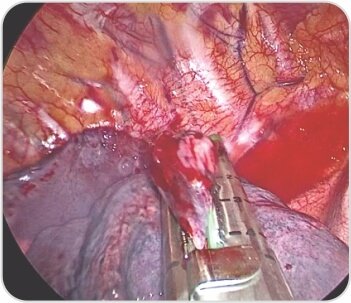 Video-Assisted Thoracoscopic Surgery of Solitary Fibrous Pleural TumorDr. BalasubramoniumMS (General Surgery), MCh(CVTS) Dr. Siva Prasad GoudMBBS, DNB (CVTS)Robotic & Minimally Invasive Thoracic Surgeon,Yashoda Hospitals, SecunderabadBACKGROUNDDIAGNOSIS & TREATMENTA 51 years old male patient came with a history of dyspnoea on exertion and purulent cough since 6 months. Pleural fluid aspiration was performed -6 times over 2 months. (1 - 1.5 litres of hemorrhagic pleural fluid was aspirated)Routine Investigations – WNLPFT:FVC – 1.26  FEV1 – 1.1  FEV1/FVC – 87.1ECHO – normal LV function , No RWMA  Pre procedure chest radiographs showingmassive right pleural effusionCT scan showing solitary fibrous right pleural tumor CTscanshowedtwolargeheterogenouslyenhancing pleural based soft tissue density lesions with neovascularity in right hemithorax measuring 14.3x13.4x11.5cm and  7.9x7.5x6.1cm.Surgery - Pleural aspiration was done and 2 litres of fluid was drained. Patient developed hemodynamic instability and was resuscitated in OT. Right posterolateral thoracotomy was performed and the tumor was removed under VATS.Post op chest X rayRight pleural tumorVideo-Assisted Thoracoscopic Surgery Uniportal Bullectomy