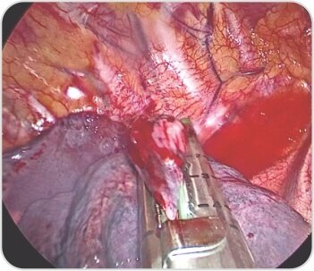 Video-Assisted Thoracoscopic Surgery of Solitary Fibrous Pleural TumorDr. BalasubramoniumMS (General Surgery), MCh(CVTS) Dr. Siva Prasad GoudMBBS, DNB (CVTS)Robotic & Minimally Invasive Thoracic Surgeon,Yashoda Hospitals, SecunderabadBACKGROUNDDIAGNOSIS & TREATMENTA 51 years old male patient came with a history of dyspnoea on exertion and purulent cough since 6 months. Pleural fluid aspiration was performed -6 times over 2 months. (1 - 1.5 litres of hemorrhagic pleural fluid was aspirated)Routine Investigations – WNLPFT:FVC – 1.26  FEV1 – 1.1  FEV1/FVC – 87.1ECHO – normal LV function , No RWMA  Pre procedure chest radiographs showingmassive right pleural effusionCT scan showing solitary fibrous right pleural tumor CTscanshowedtwolargeheterogenouslyenhancing pleural based soft tissue density lesions with neovascularity in right hemithorax measuring 14.3x13.4x11.5cm and  7.9x7.5x6.1cm.Surgery - Pleural aspiration was done and 2 litres of fluid was drained. Patient developed hemodynamic instability and was resuscitated in OT. Right posterolateral thoracotomy was performed and the tumor was removed under VATS.Post op chest X rayRight pleural tumorVideo-Assisted Thoracoscopic Surgery Uniportal Bullectomy