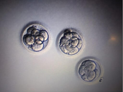 Very Low Ovarian Reserve With Endometriosis