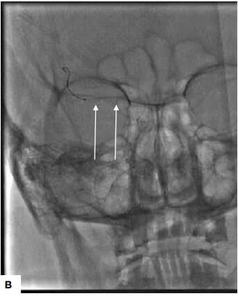 acute left hemiparesis and aphasia