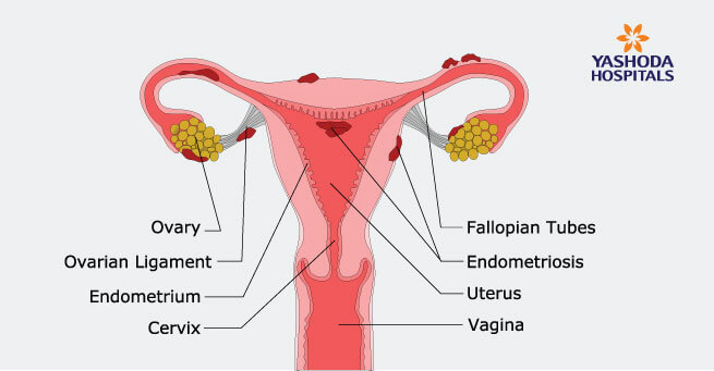 endometriosis