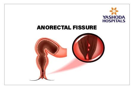 Non-surgical simple management for anal fissure with botox injection