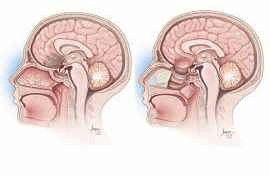 Pituitary Surgery