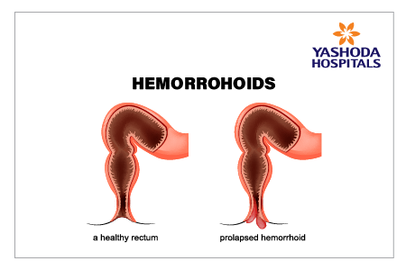 hemorrohoids