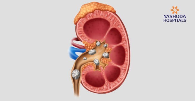 kidney stones