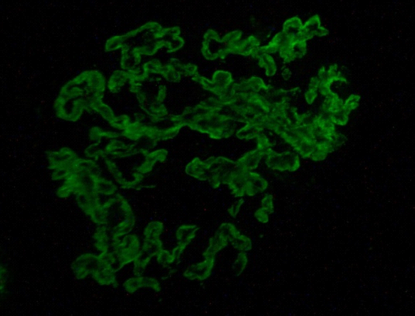 showing C1q which shows significant peripheral and focal mesangial immune deposits (IgG, IgM, C3c not shown)