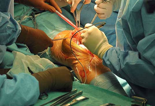 Total knee replacement Surgery Cost in Hyderabad, India