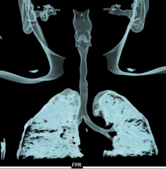 rigid bronchoscopic dilatation