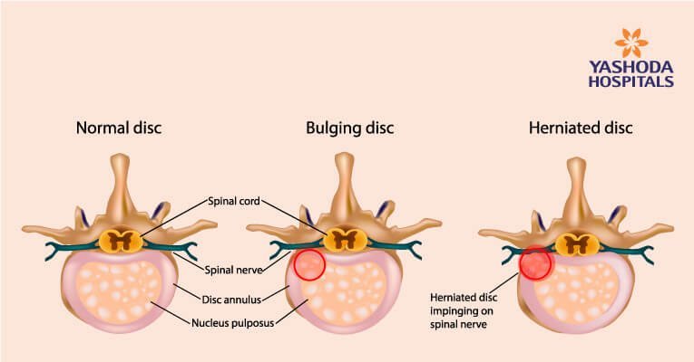 slipped herniated disc or lumbar disc disease