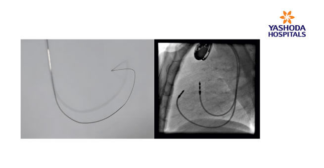 the right ventricular tract