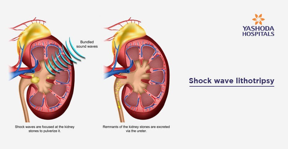 treatment for kidney stones