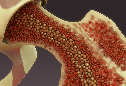 Bone marrow transplant-treatment procedure