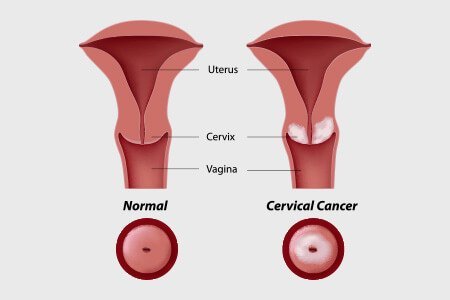 What is Cervical Cancer