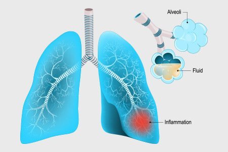 respiratory tract infection