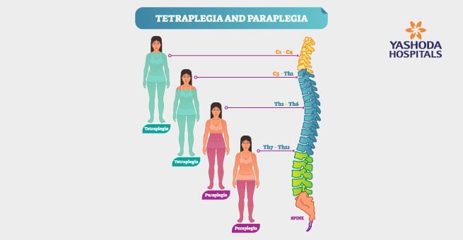 types of spinal cord injury