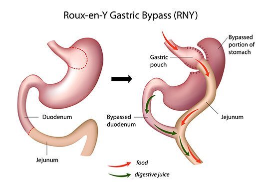  Bariatric surgery cost in India.